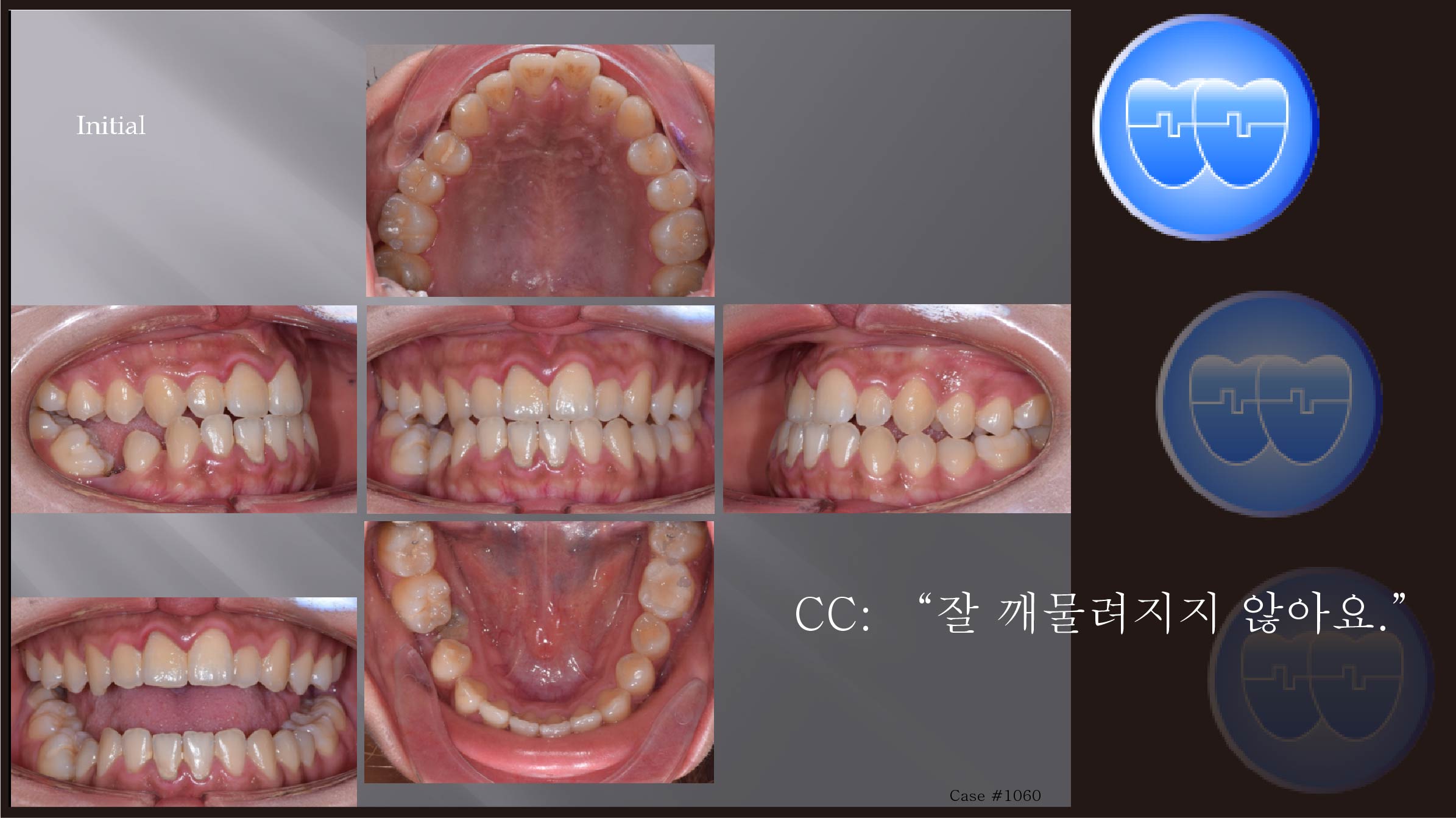 교정 Case 1060.  L5 발치, Class III, Lower Lingual Corticotomy, Sem #12.8