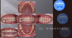 교정 Case 1060.  L5 발치, Class III, Lower Lingual Corticotomy, Sem #12.8