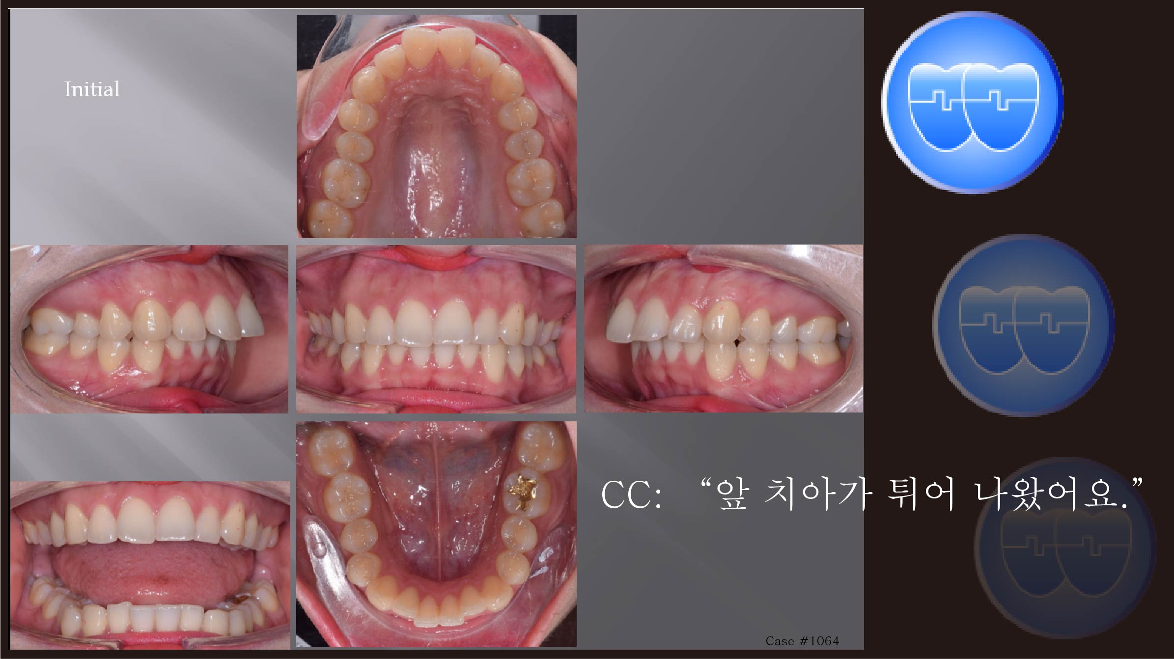 교정 Case 1064.  U4 발치, Severe Overjet, Class II, Root Resorption, Sem #12.5