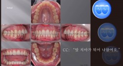 교정 Case 1064.  U4 발치, Severe Overjet, Class II, Root Resorption, Sem #12.5