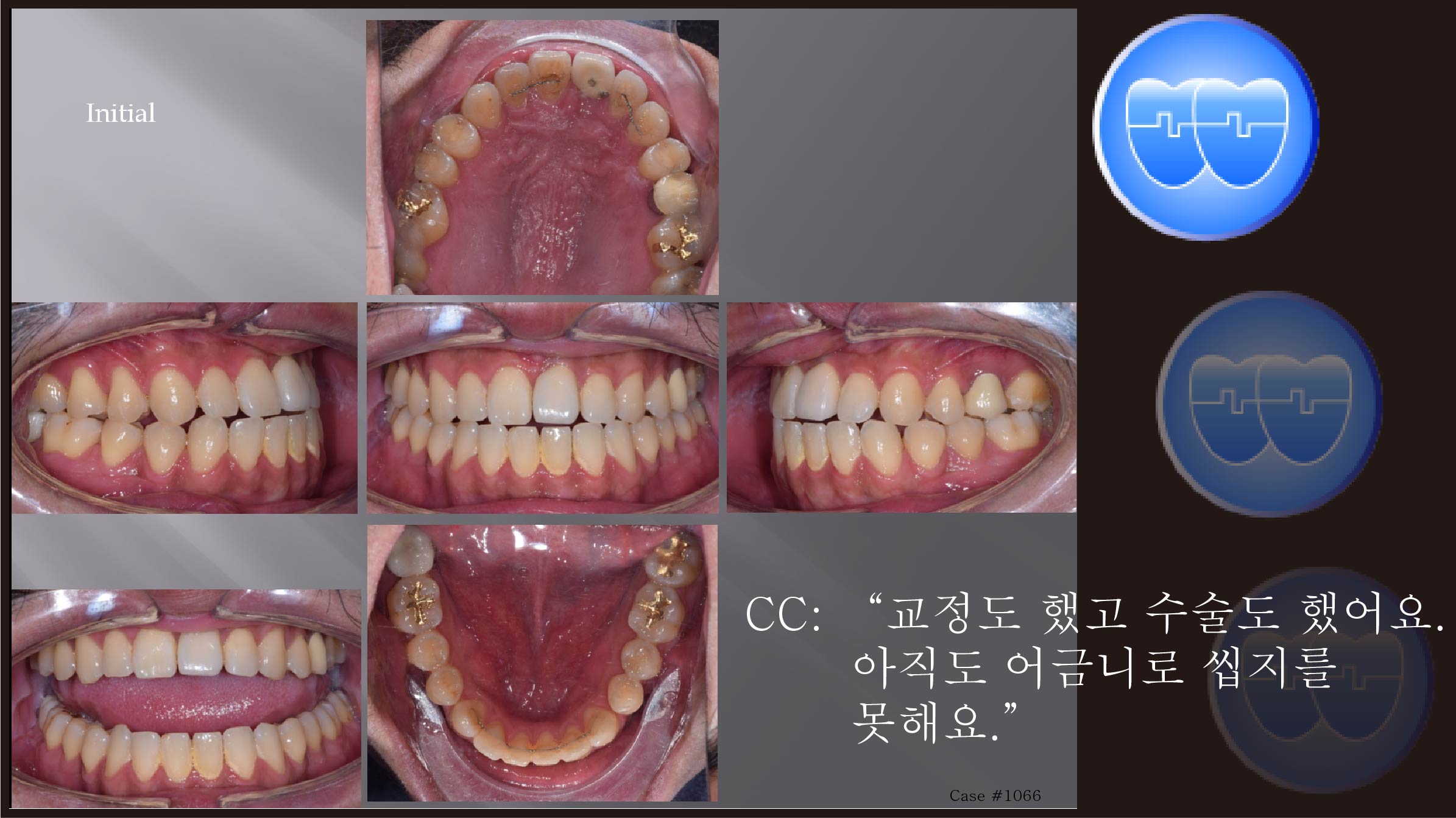 교정 Case 1066.  재교정, 비발치, Lower Lingual Corticotomy, Bilateral Posterior Crossbite, Sem #7.8