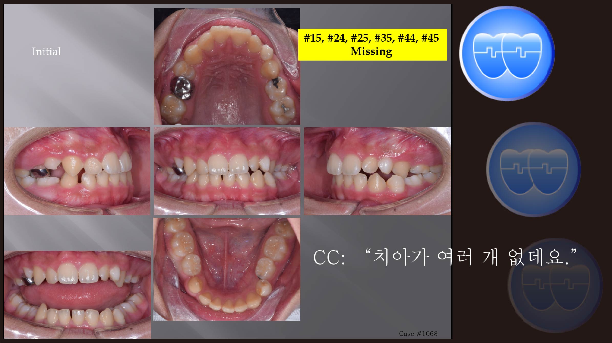 교정 Case 1068.  Multiple Congenital Missed Bicuspids, Sem #13.2