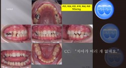 교정 Case 1068.  Multiple Congenital Missed Bicuspids, Sem #13.2