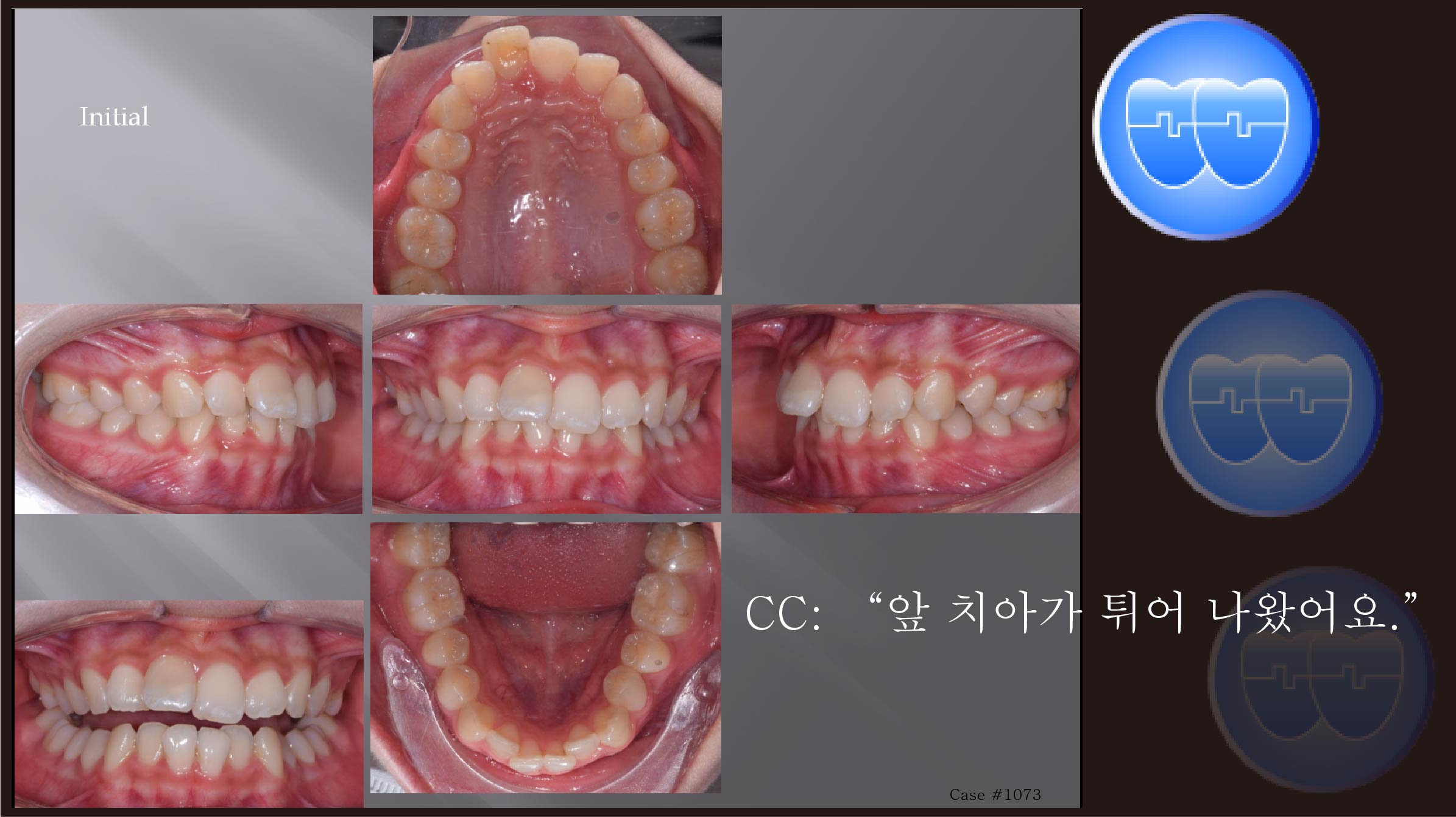 교정 Case 1073.  비발치, Big Overjet, Lateral Expansion, Root Resorption, Sem #6