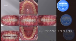 교정 Case 1073.  비발치, Big Overjet, Lateral Expansion, Root Resorption, Sem #6