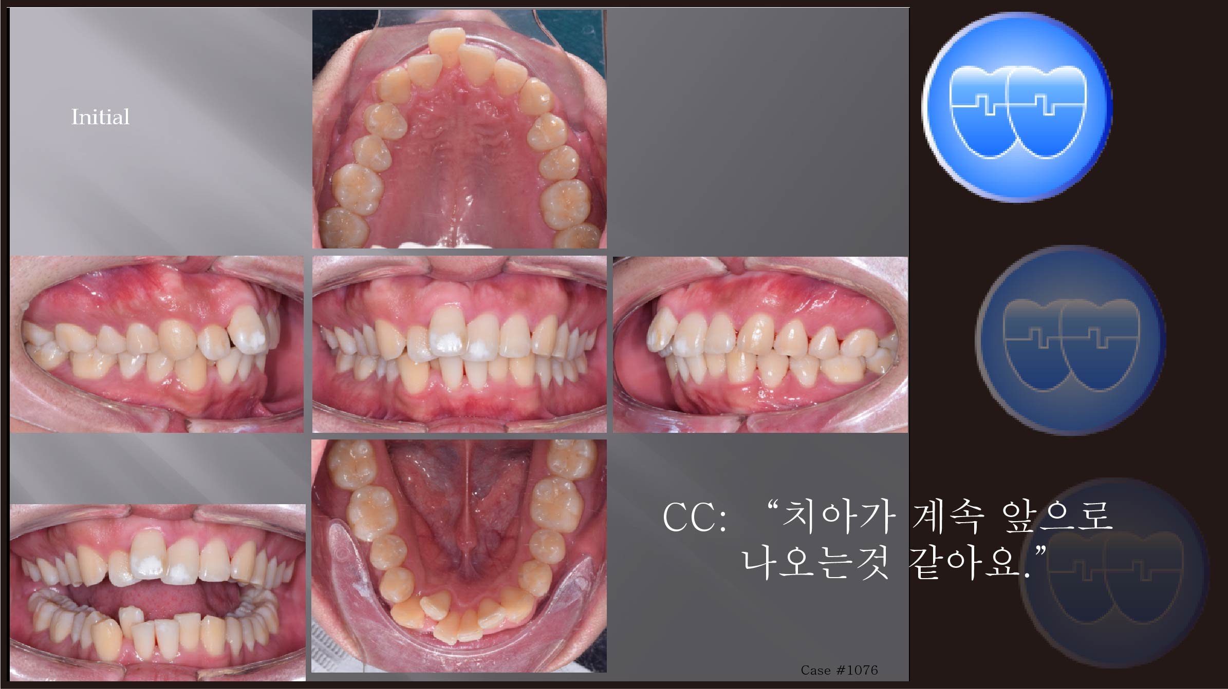 교정 Case 1076.  U5L1 발치, Severe Overjet, Gummy Smile, Sem #13