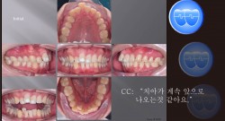 교정 Case 1076.  U5L1 발치, Severe Overjet, Gummy Smile, Sem #13