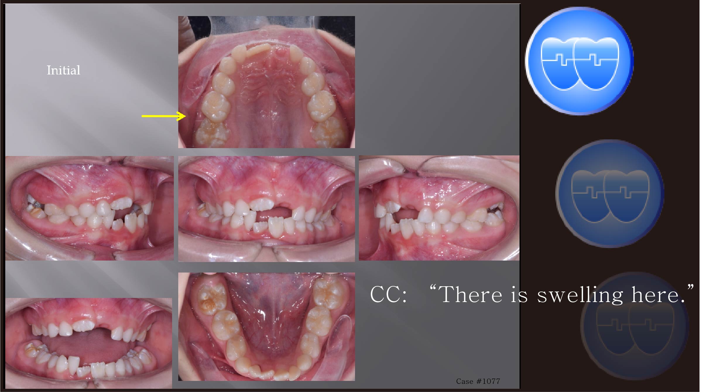 교정 Case 1077.  1차 교정, Upper Molar Impacted, Sem #9