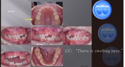 교정 Case 1077.  1차 교정, Upper Molar Impacted, Sem #9