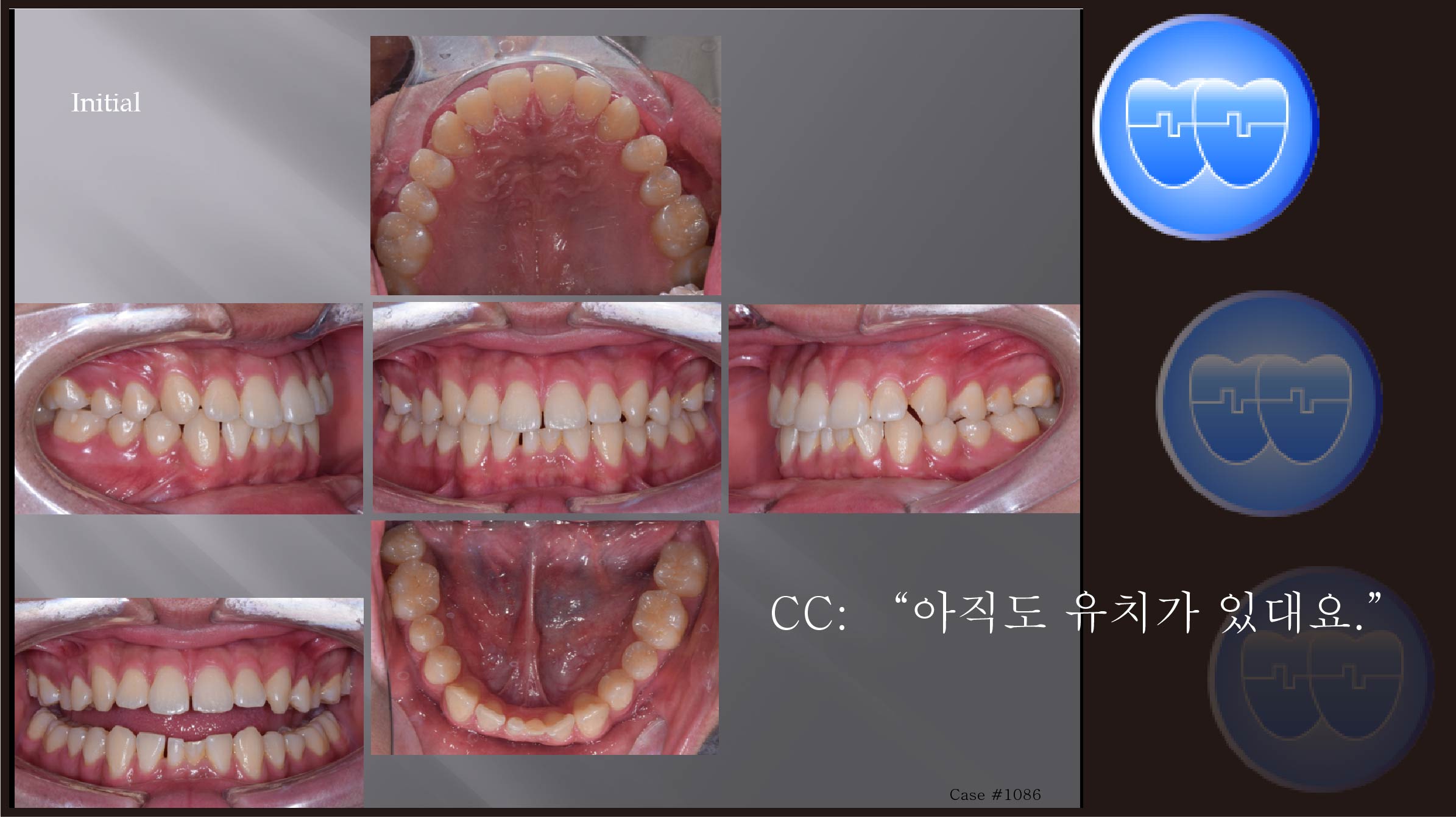 교정 Case 1086.  L1 발치, Congenital Missing Lower Incisors, Sem #13