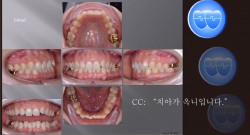 교정 Case 1092.  비발치, Class II Div. 2, Detorqued Anterior Teeth, Deepbite, Sem #2