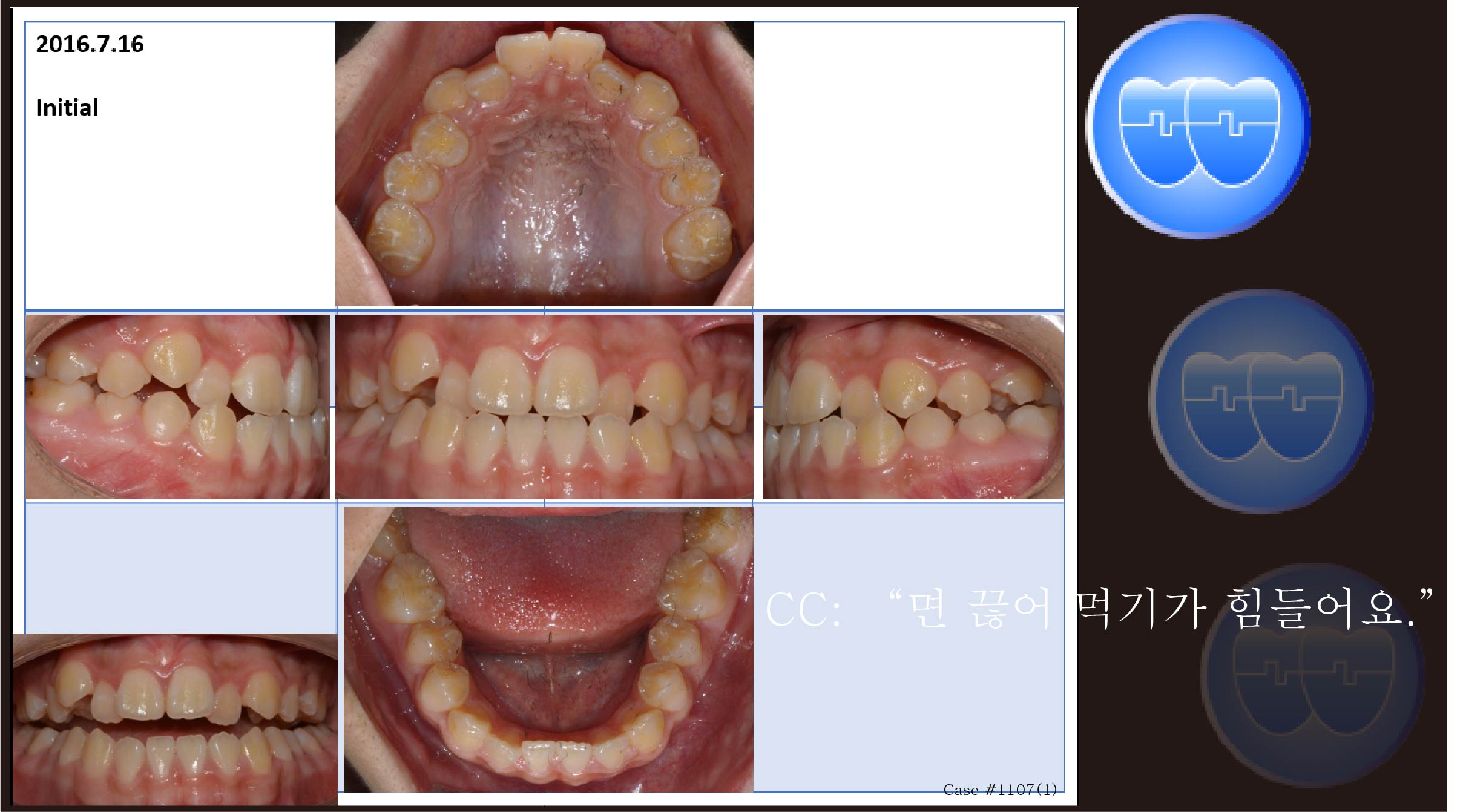 교정 Case 1107(1).  U5L4 발치, Class III, Corticotomy 필요, 타치과 Case로 Refer 되어 옴, Sem #13.7