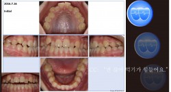 교정 Case 1107(1).  U5L4 발치, Class III, Corticotomy 필요, 타치과 Case로 Refer 되어 옴, Sem #13.7