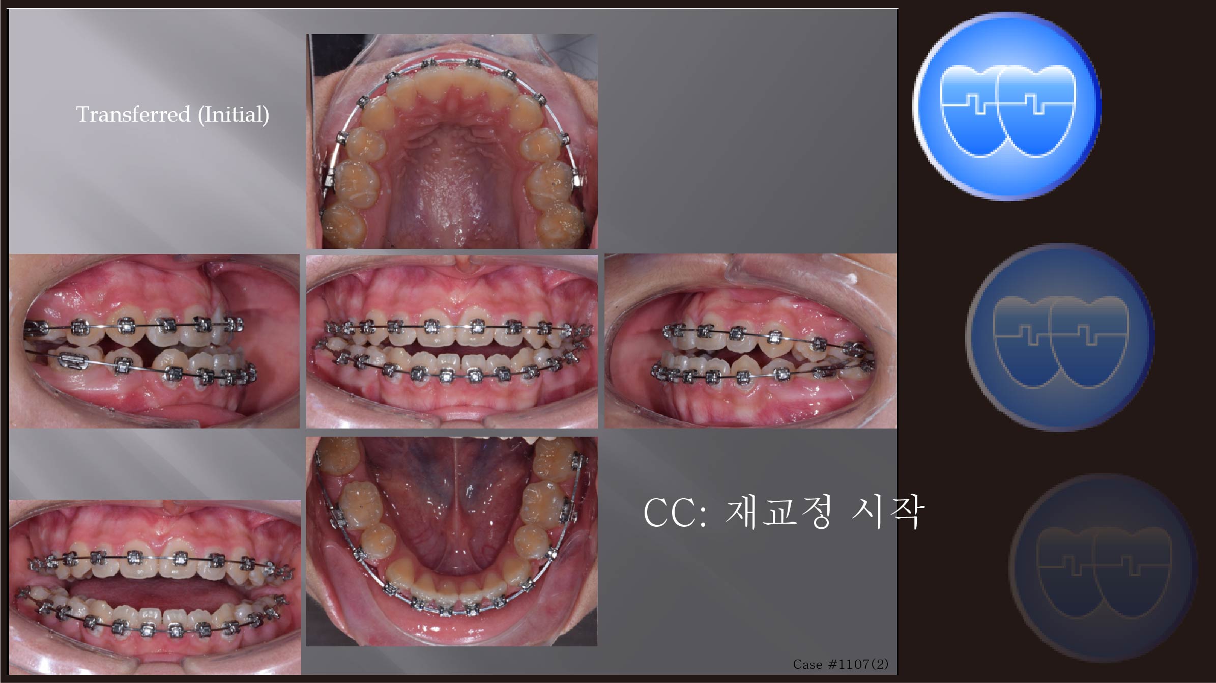 교정 Case 1107(2).  재교정, U5L4 발치, Lower Lingual Corticotomy, Sem #13.7