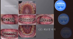 교정 Case 1107(2).  재교정, U5L4 발치, Lower Lingual Corticotomy, Sem #13.7