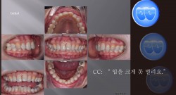 교정 Case 1117.  비발치, TMJ, Deepbite, Sem #19