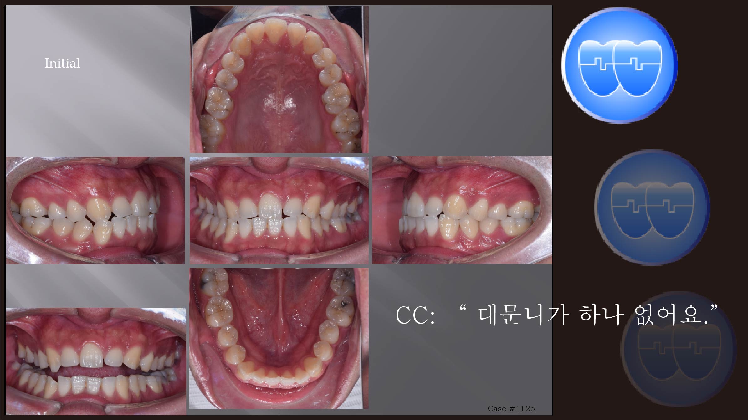 교정 Case 1125.  비발치, #21 Missing, Upper Midline, Sem #13