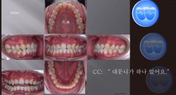 교정 Case 1125.  비발치, #21 Missing, Upper Midline, Sem #13