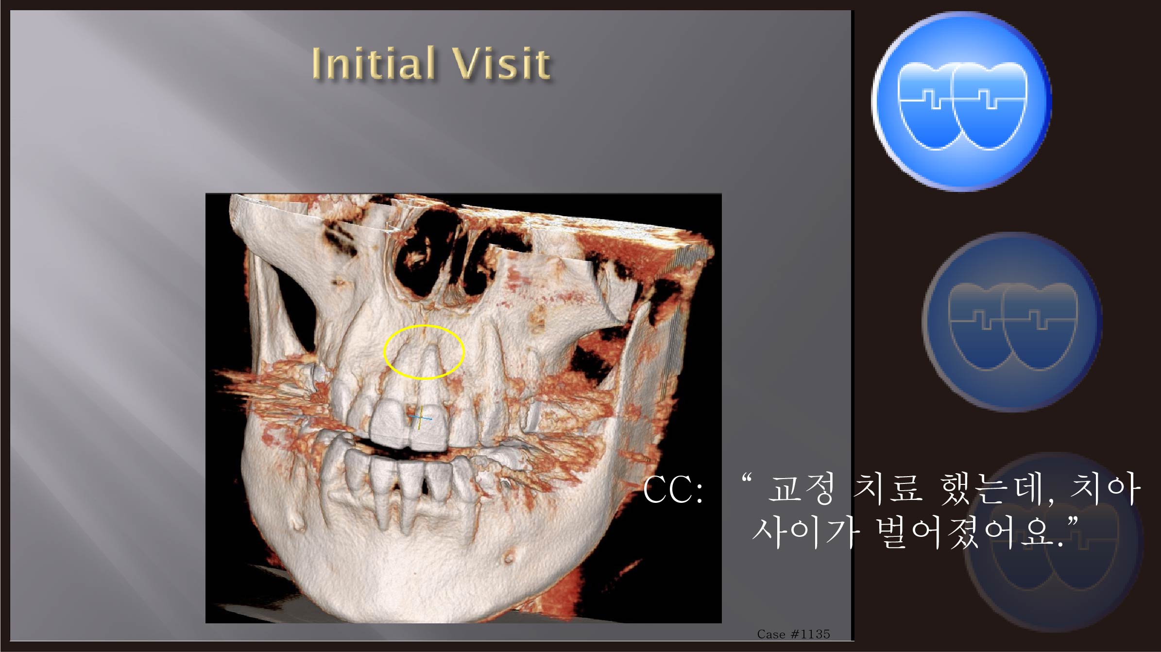 교정 Case 1135.  재교정, 투명교정, #21번 신경 죽었다 살아남, Sem #12.1