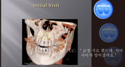 교정 Case 1135.  재교정, 투명교정, #21번 신경 죽었다 살아남, Sem #12.1