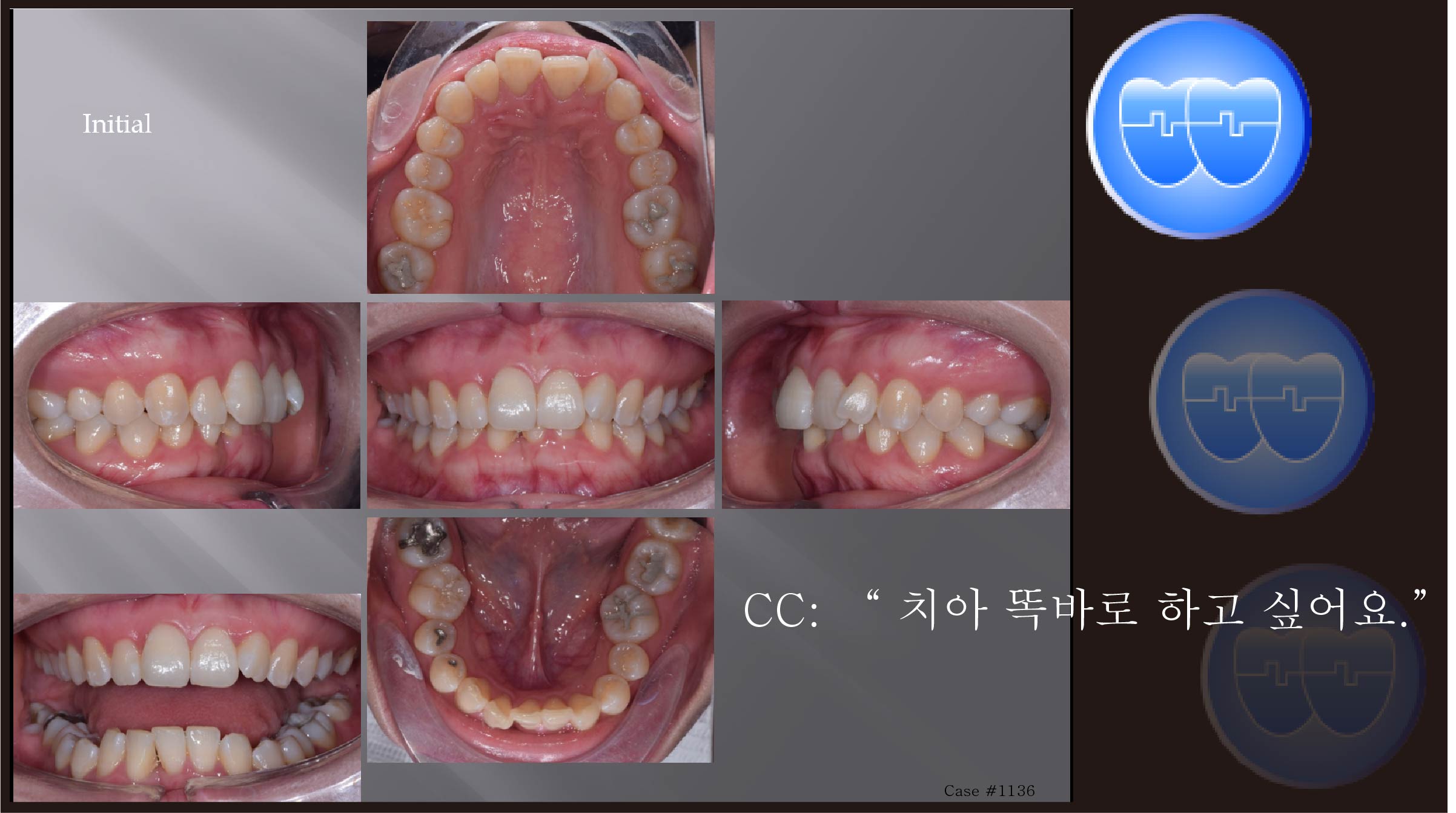 교정 Case 1136.  U5L1 발치, Dental Deepbite, Gummy Smile, Sem #7.5