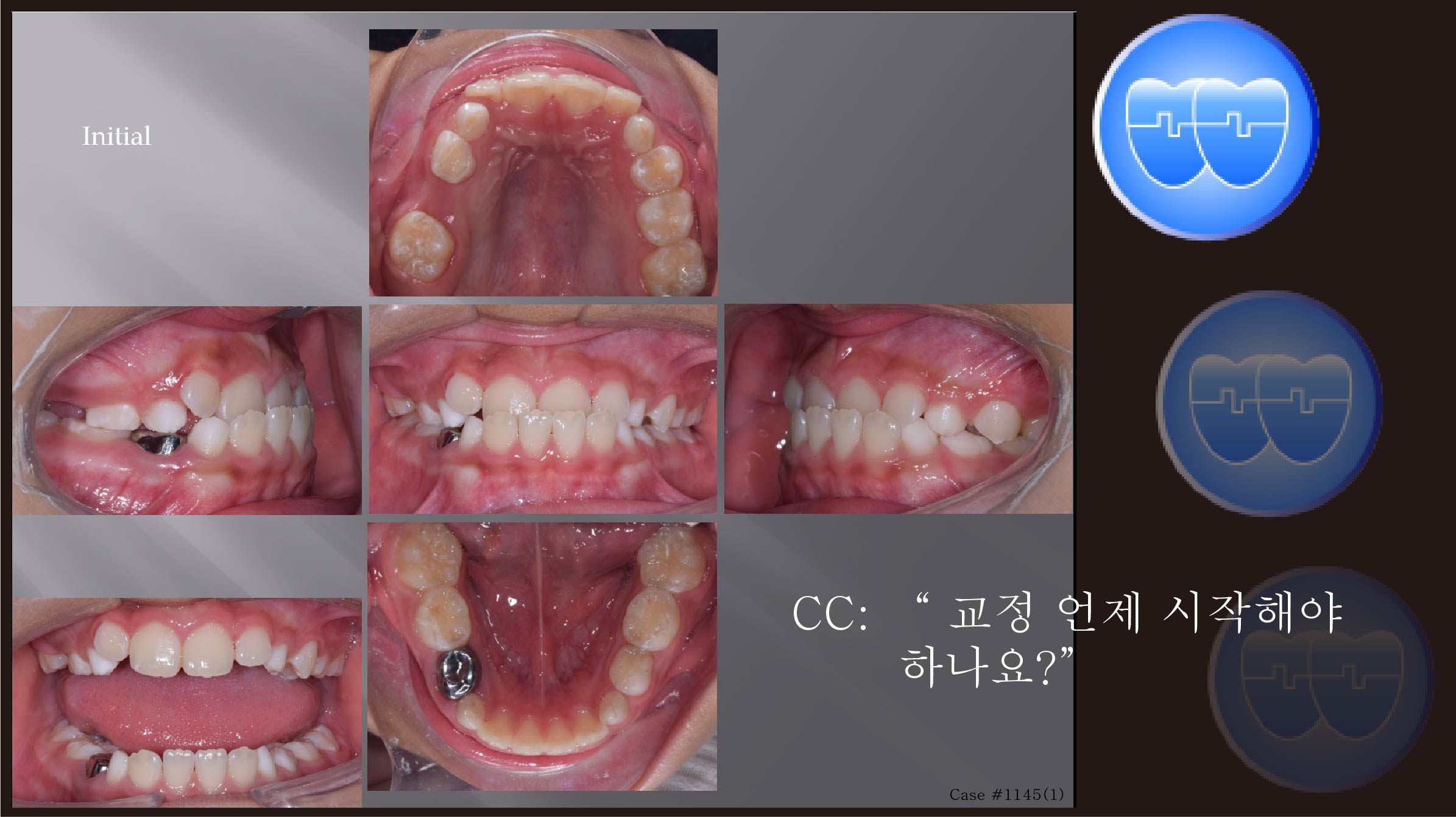 교정 Case 1145(1).  1차 교정, Anterior Crossbite, Advancing Z Arch, RHG, Sem #9