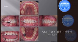 교정 Case 1145(1).  1차 교정, Anterior Crossbite, Advancing Z Arch, RHG, Sem #9