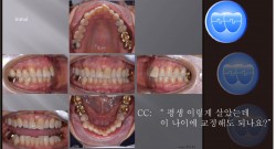 교정 Case 1153.  부분교정, 성인교정, Anterior Crowding, Sem #5