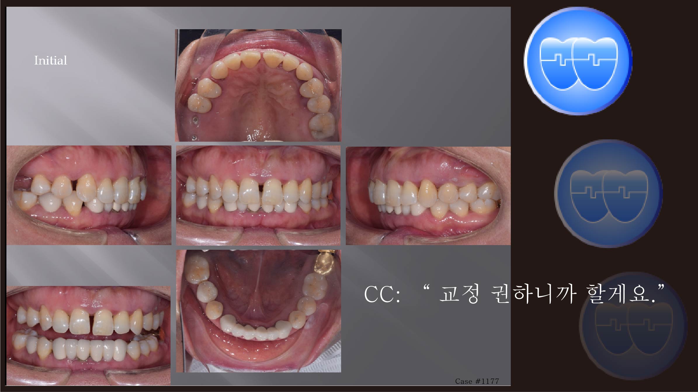 교정 Case 1177.  비발치, 부분교정, Prosth-Ortho., Perio-Ortho., Sem #20.5