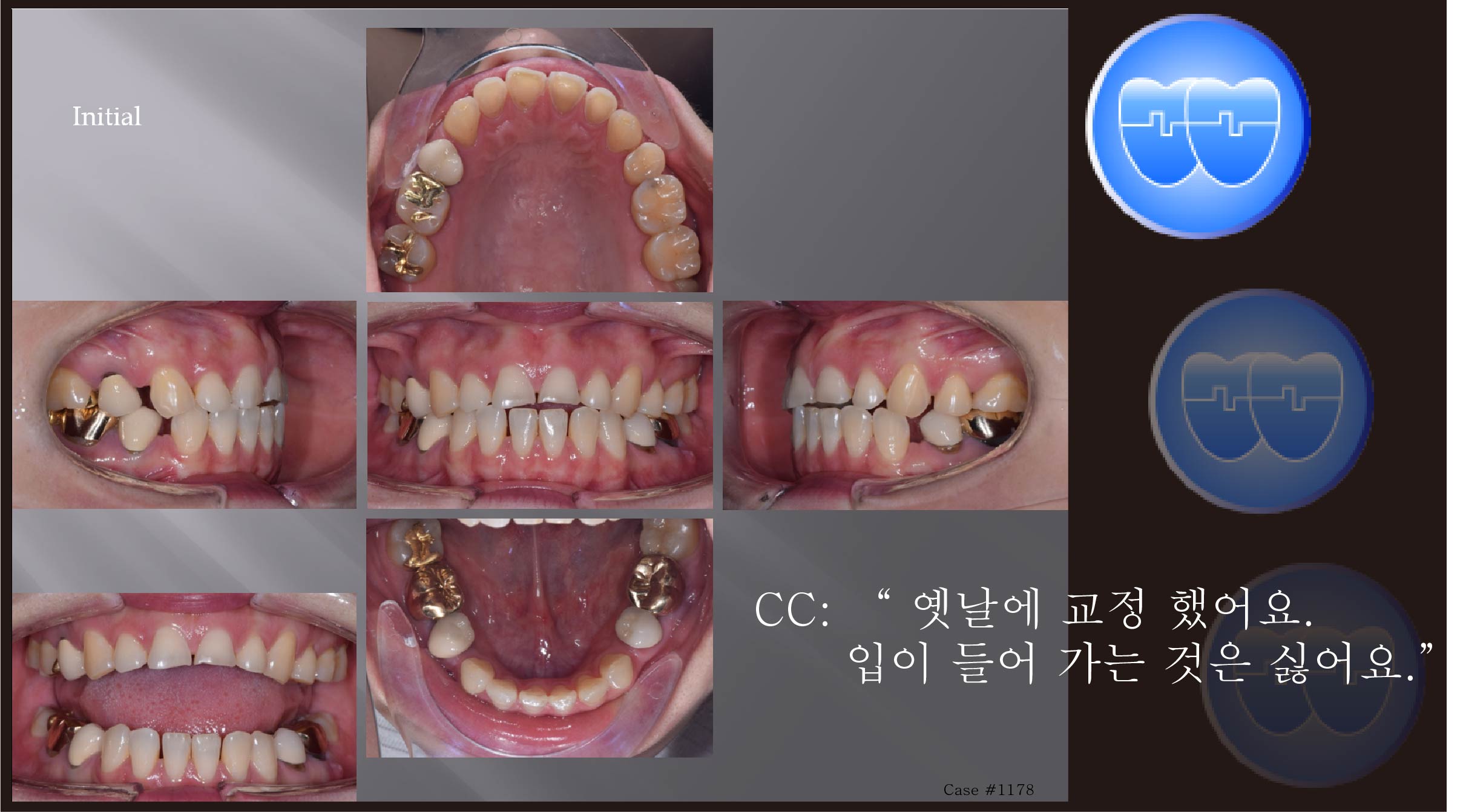 교정 Case 1178.  재교정, Damaged Crowns and Roots, Prosth-Ortho. Sem #20.5