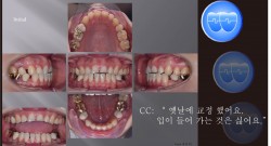 교정 Case 1178.  재교정, Damaged Crowns and Roots, Prosth-Ortho. Sem #20.5