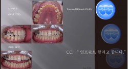 교정 Case 1182.  부분교정, Space Gaining for Implant #15, Sem #20.5