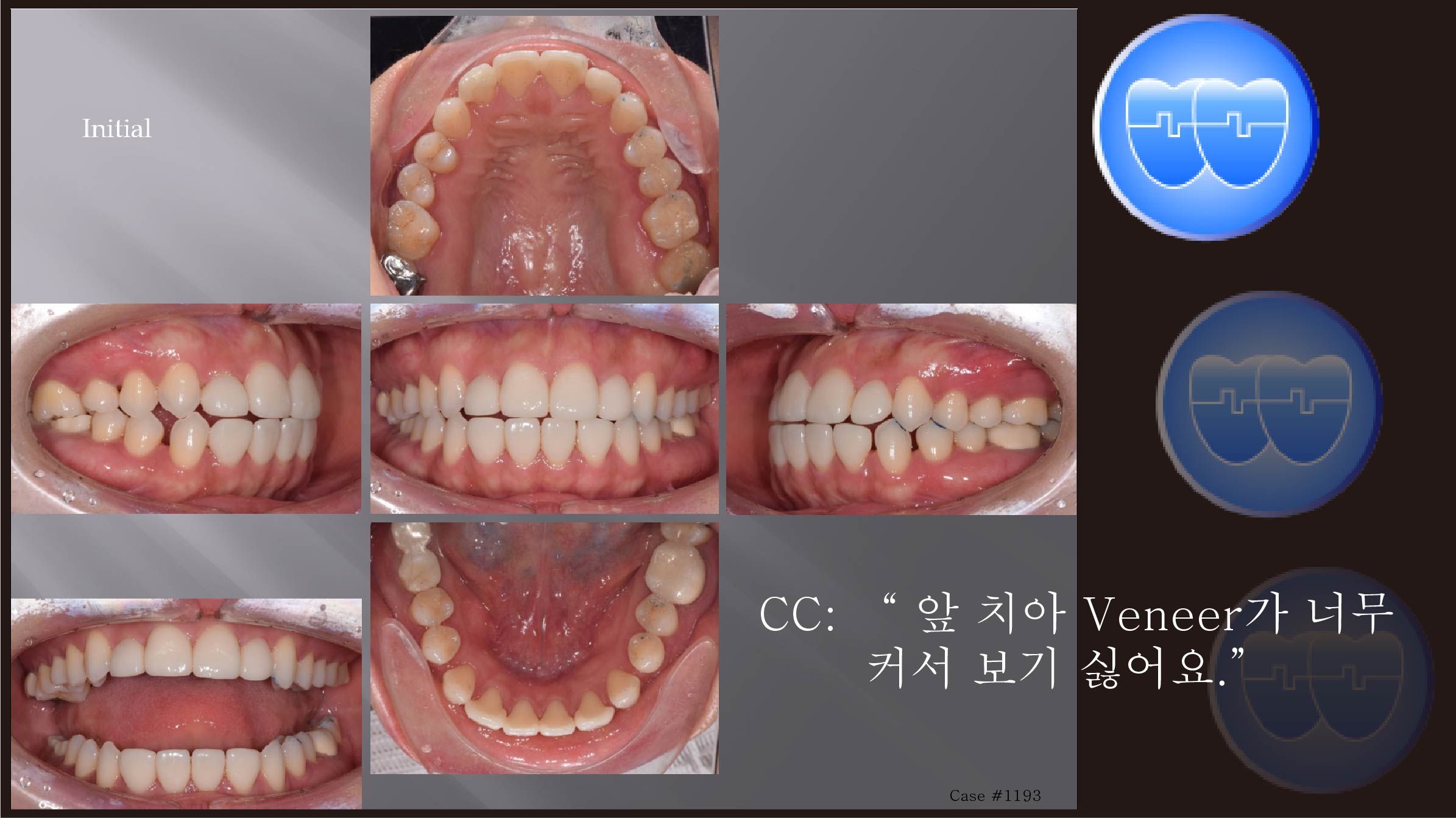 교정 Case 1193.  비발치, 부분교정, Space, Anterior Laminate Veneers, Sem #11