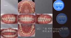 교정 Case 1193.  비발치, 부분교정, Space, Anterior Laminate Veneers, Sem #11