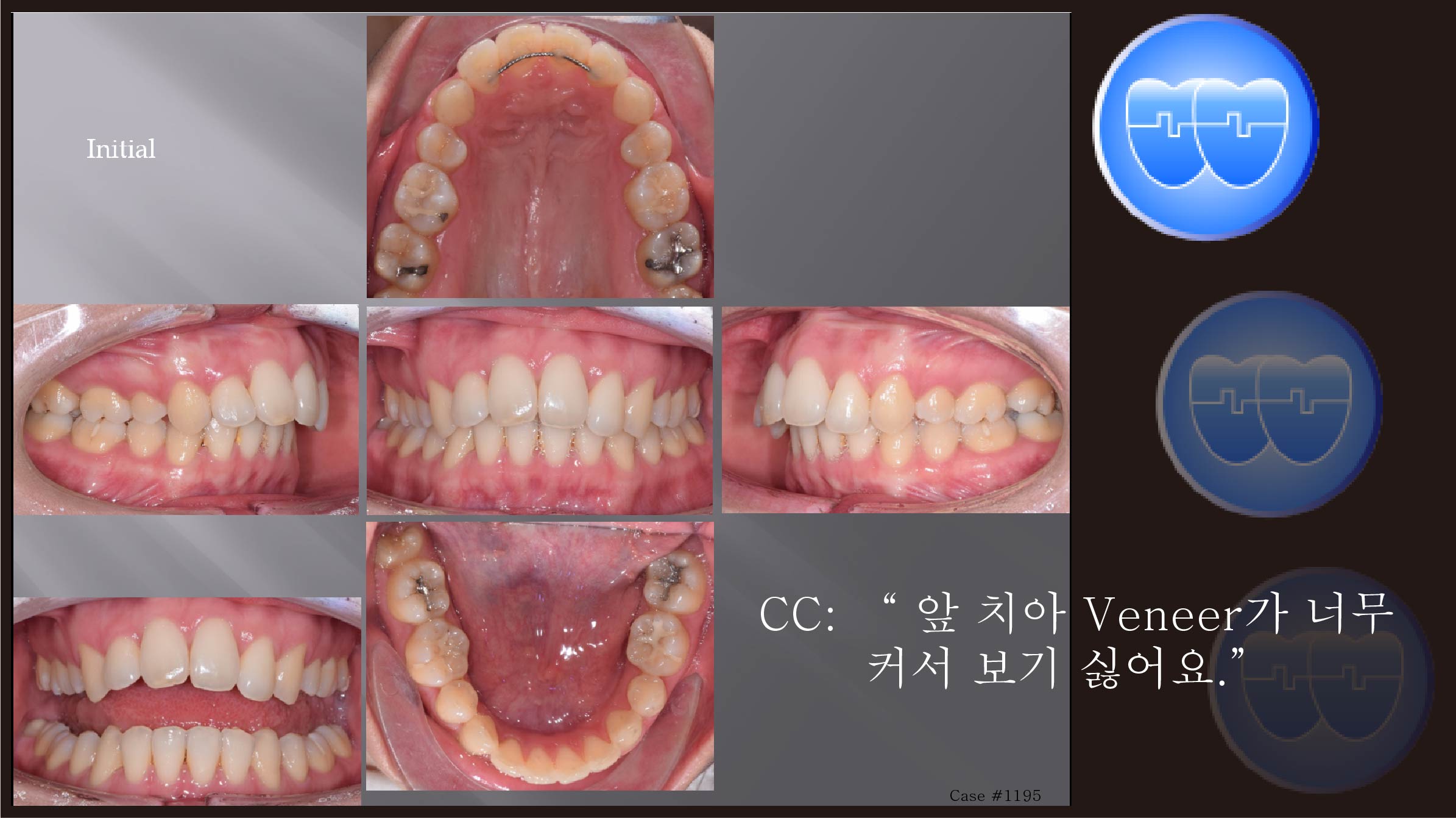 교정 Case 1195.  재교정, 교정 Case 202로 부터 연결, Sem #12.2