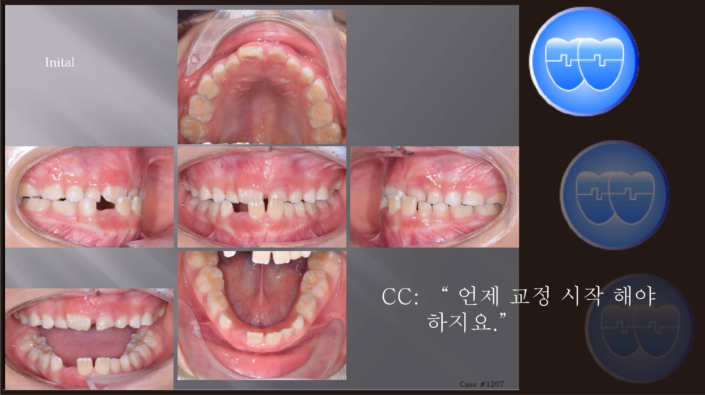 교정 Case 1207.  1차 교정, Anterior Crossbite, RHG, Sem #9