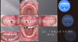 교정 Case 1207.  1차 교정, Anterior Crossbite, RHG, Sem #9