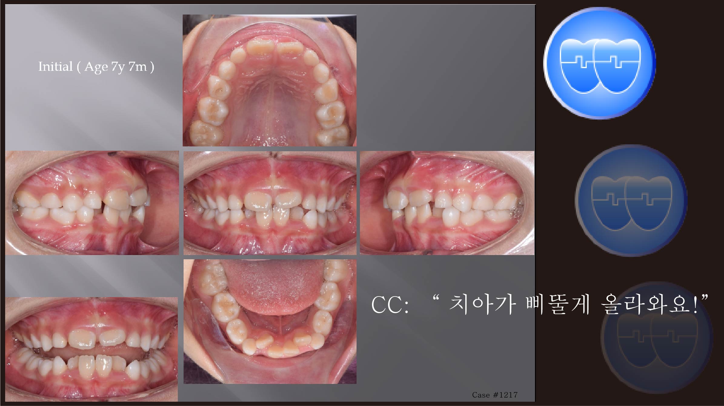 교정 Case 1217.  1차 교정, Lower Crowding, #12 Crossbite, Sem #9