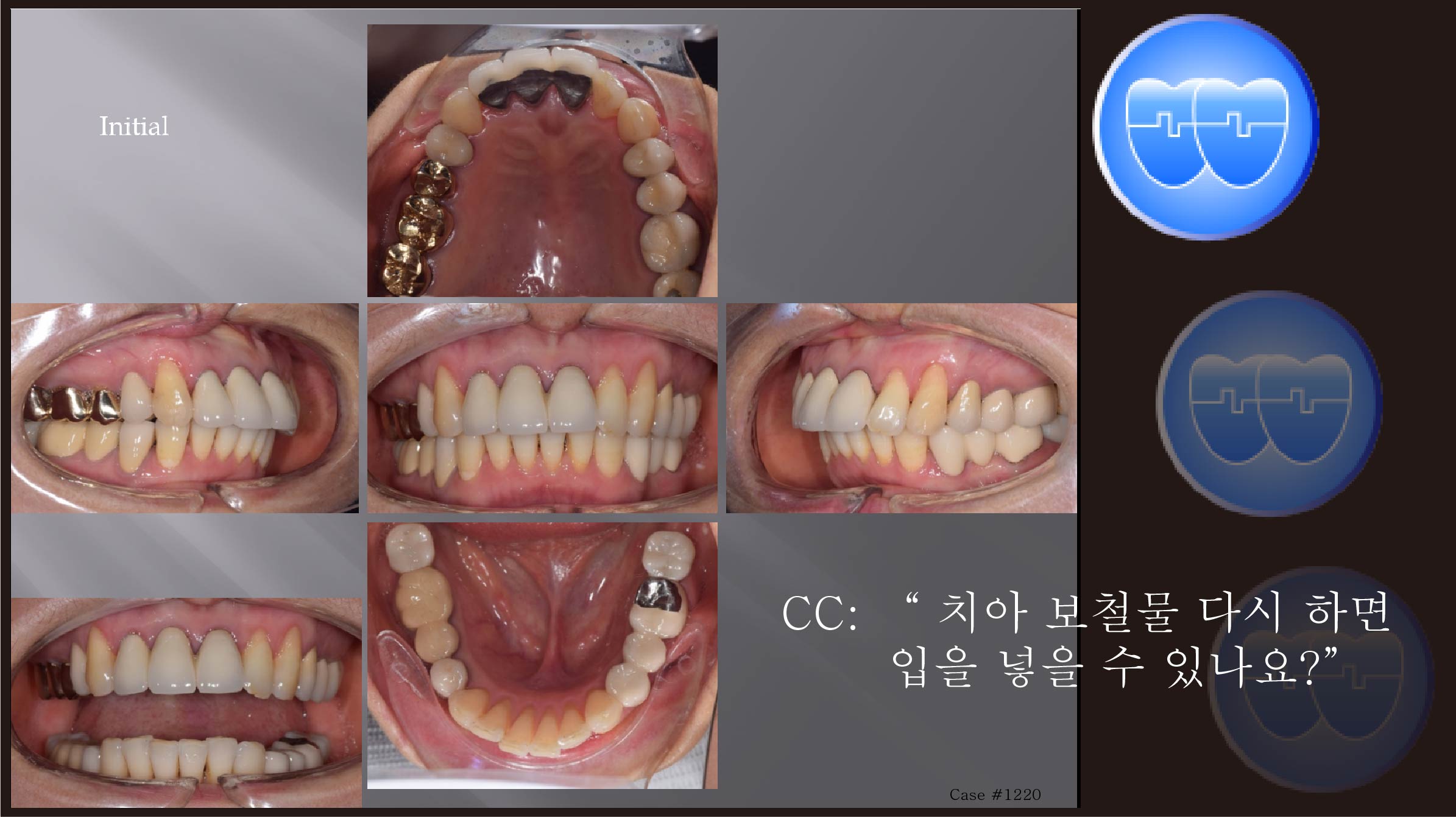 교정 Case 1220.  부분교정, Prosth-Ortho, Proclined Upper Incisors, Sem #5