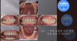 교정 Case 1220.  부분교정, Prosth-Ortho, Proclined Upper Incisors, Sem #5