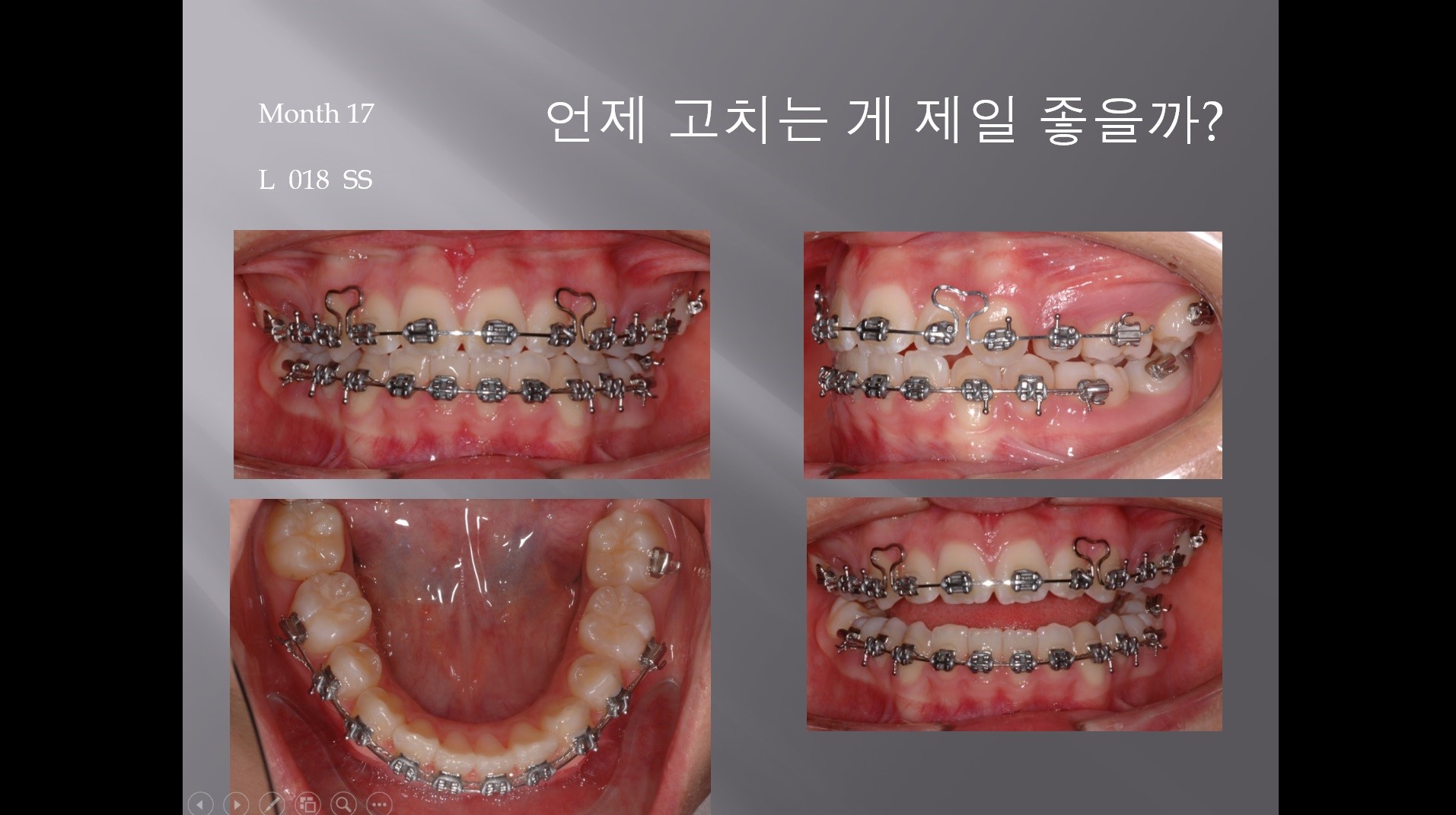 (실습 9) Posterior Cross Elastics and Metal Button