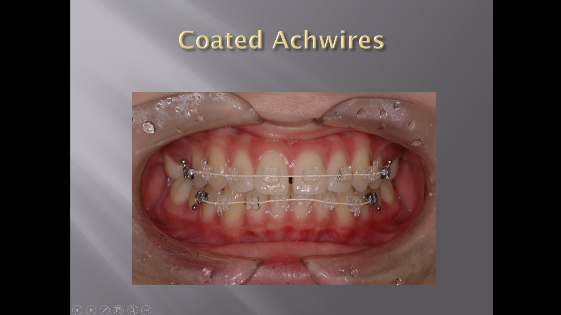 (실습 30) Coated Archwires