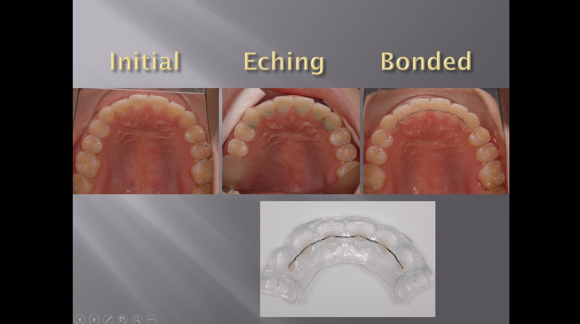 (실습 32) Lingual Fixation Wires