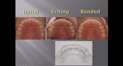 (실습 32) Lingual Fixation Wires