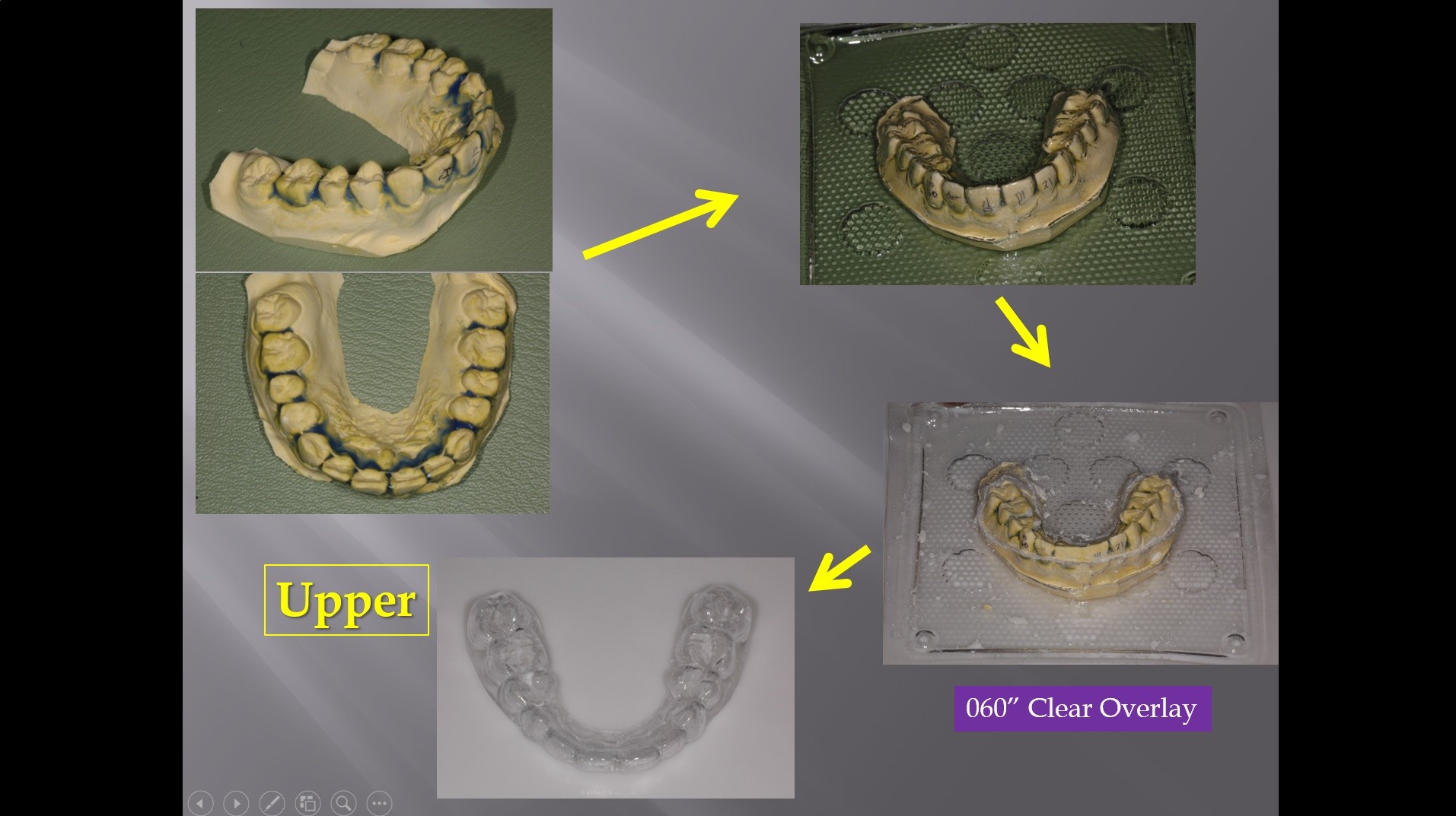 (실습 33) Clear Overlay Retainer