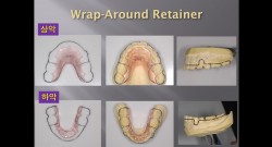 (실습 34) Wrap-around Retainer