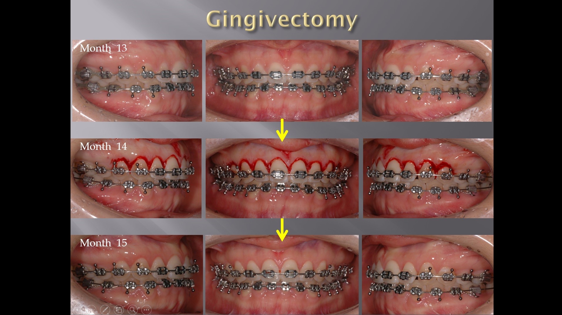 (실습 37) Gingivectomy and Alveoloplasty