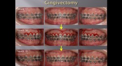 (실습 37) Gingivectomy and Alveoloplasty