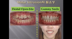 (실습 39) Molar Intrusion