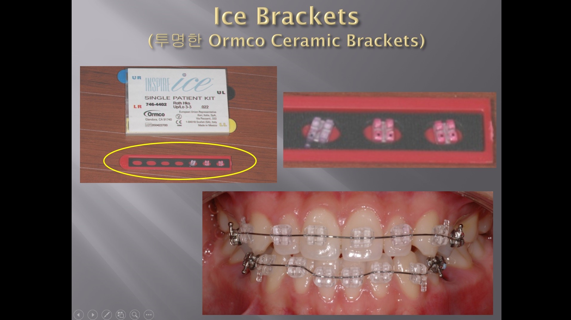 (실습 41) Ceramic Brackets의 종류와 선택